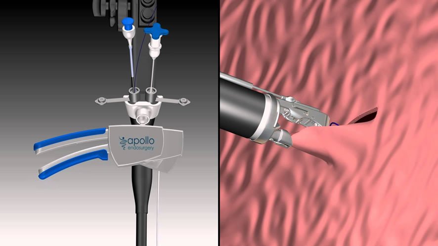 Gastroplastia Endoscópica