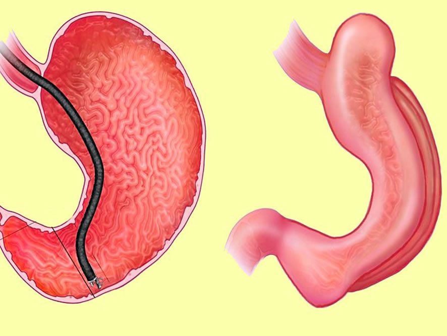 Imagem cedida pelo Dr.Eduardo Grecco,Paciente após 45 dias de Gastroplastia endoscopica