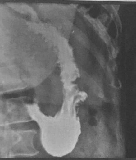 img-tratamento-gastroplastia-02