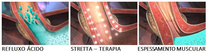 COMO FUNCIONA O STRETTA®