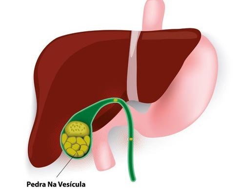 tratamento-vesicula